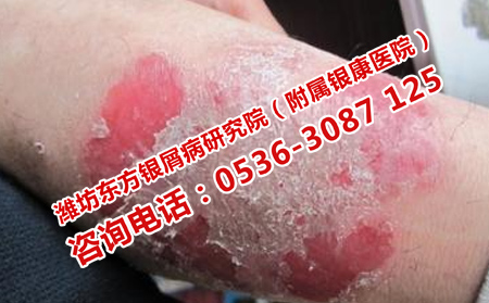 銀屑病的治療方法是什么