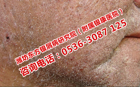 如何治療過敏引起的銀屑病