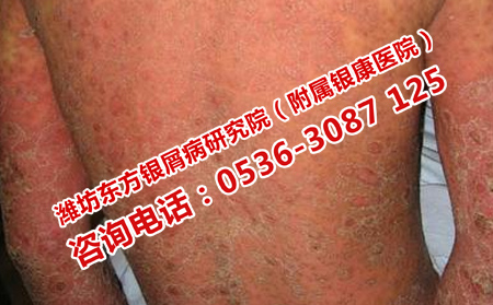 濰坊哪個醫院治療銀屑病可以