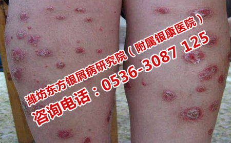 哪種方法治療銀屑病效果好