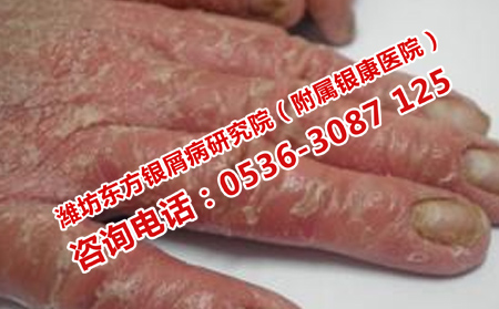 壓力大造成銀屑病怎么治療