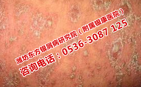 牛皮癬患者注意哪些飲食問題