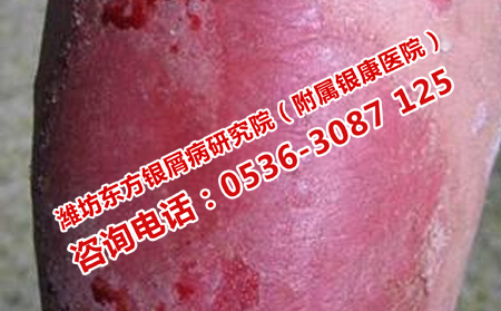 如何護理牛皮癬患者的肌膚