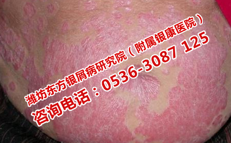 銀屑病的治療應該怎么做