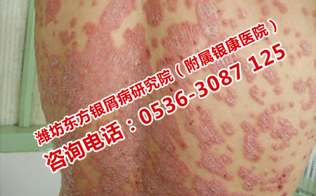 膿包型牛皮癬的皮膚護(hù)理方法