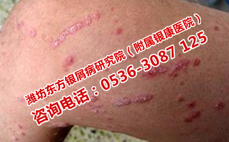 頑固牛皮癬應該怎么治療呢