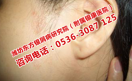 面部牛皮癬怎樣治療