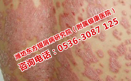 牛皮癬的外部因素有哪些