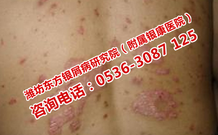 治療牛皮癬的錯誤方法