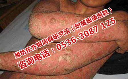 如何使局部牛皮癬不加重