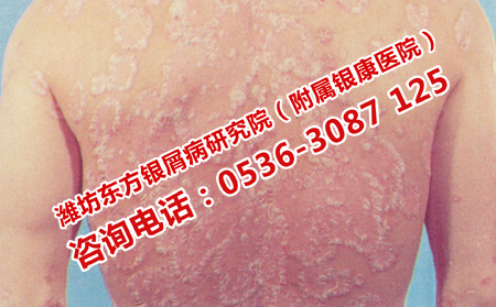 為什么牛皮癬總是治不可以