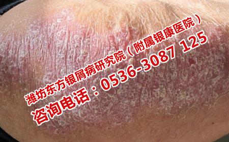 如何治療復雜的牛皮癬