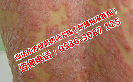 如何預防牛皮癬再次發(fā)作