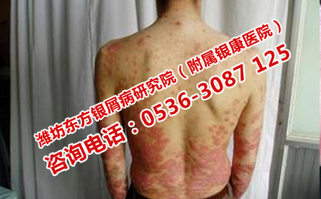 如何把牛皮癬治好