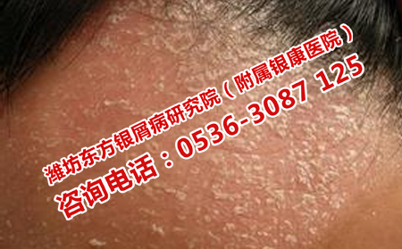 牛皮癬有哪些危害呢