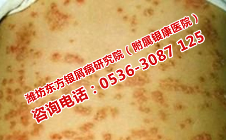 如何控制牛皮癬病情