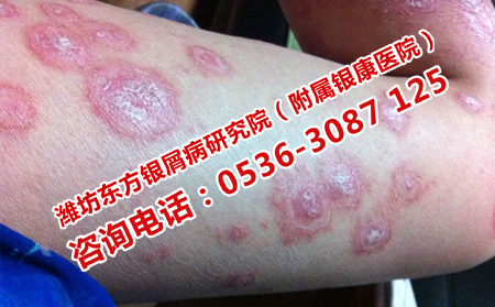 怎么治療患病多年的牛皮癬