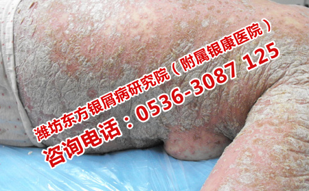 如何辯證治療牛皮癬呢