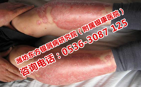 年輕女性為什么得了牛皮癬