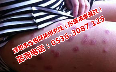 物理光療治療銀屑病如何