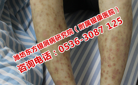 青州治牛皮癬的醫(yī)院