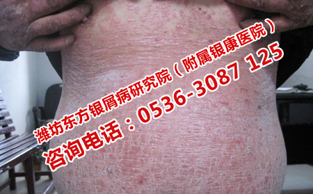 安丘治銀屑病哪家醫院可以