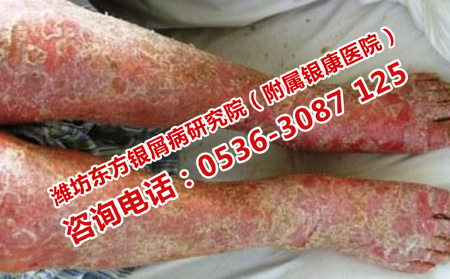 怎樣減少容易復(fù)發(fā)的牛皮癬的復(fù)發(fā)