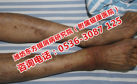 濰坊銀屑病醫院世界銀屑病日