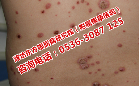 銀屑病去哪里治療好