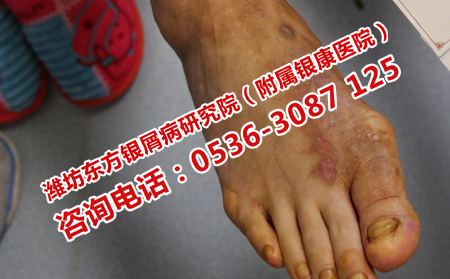 濰坊市口碑好的銀屑病醫(yī)院