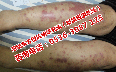 治牛皮癬的專業醫院