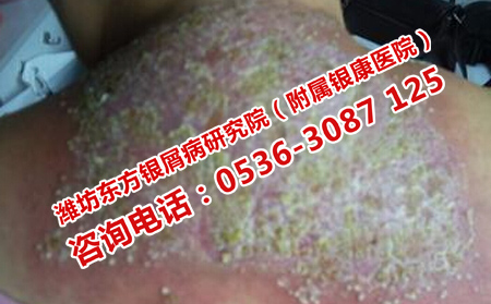 坊子區去哪里治銀屑病