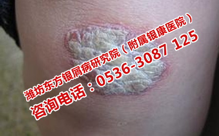 奎文區有專科銀屑病醫院嗎