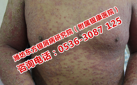 銀屑病恢復去哪里醫院