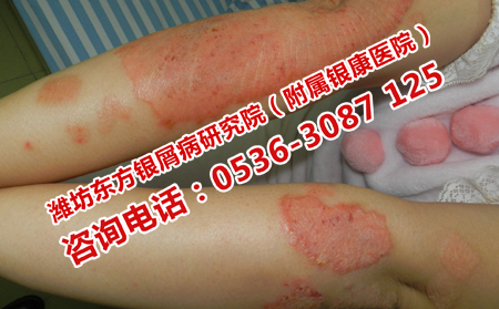 銀屑病遺傳概率