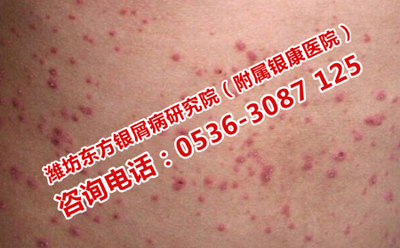 尋常性銀屑病的癥狀