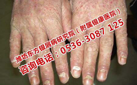 銀屑病病情不穩注意的飲食問題