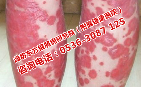 紅皮型銀屑病的預防方法