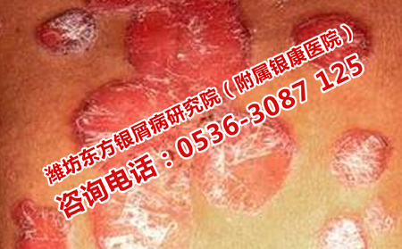 治療銀屑病的可以醫院