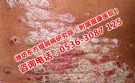 濰坊能治好膿皰型牛皮癬嗎