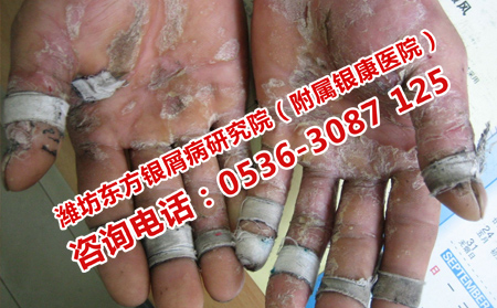 銀屑病復(fù)發(fā)去哪里看