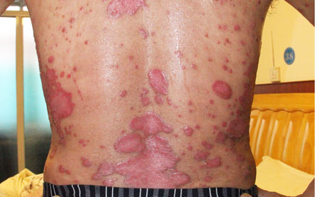 重癥銀屑病如何治療呢