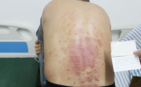 去除牛皮癬的辦法是