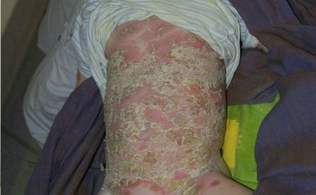 奎文區治療銀屑病好的醫院