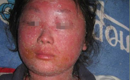 紅皮型銀屑病治得可以嗎