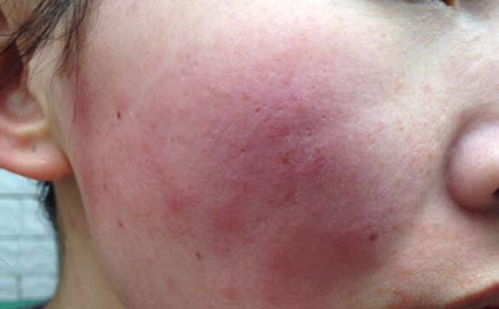 濰坊銀屑病治療費