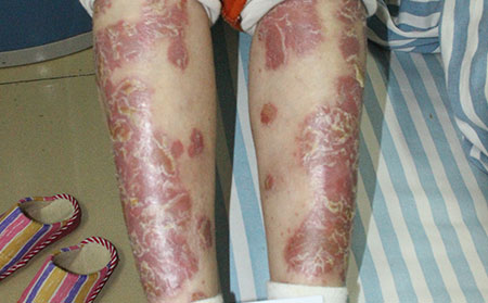 孕婦銀屑病患者會影響孩子嗎