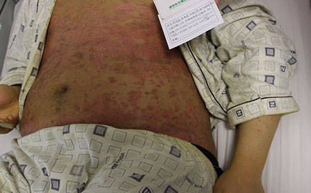 科學護理紅皮型銀屑病的辦法