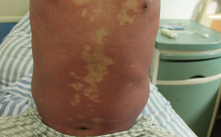 如何預(yù)防銀屑病的復(fù)發(fā)