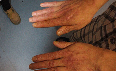 濰坊銀屑病醫(yī)院治療價(jià)格